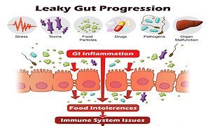 The Microbiome, Dysbiosis & Leaky Gut. Leaky Gut